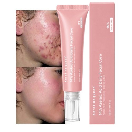 Custom logo 14% Azelaic Acid Repair Cream for Hormonal Acne Redness Rosacea Fade Dark